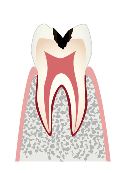 C2 歯の内部まで進行したむし歯